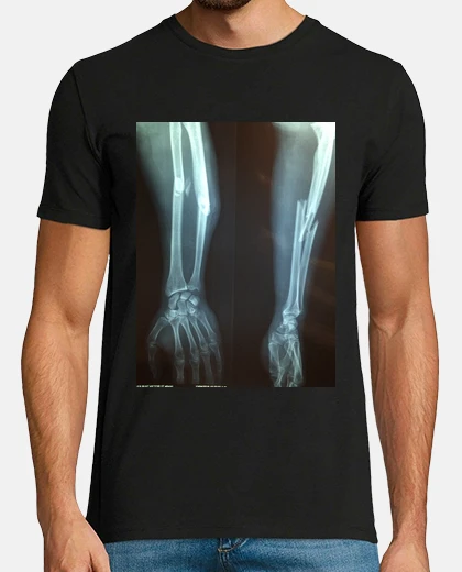 T-shirt frattura del braccio radiografico